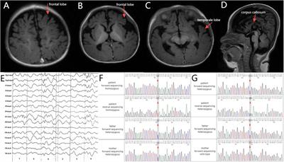 WWOX-related epileptic encephalopathy caused by a novel mutation in the WWOX gene: a case report